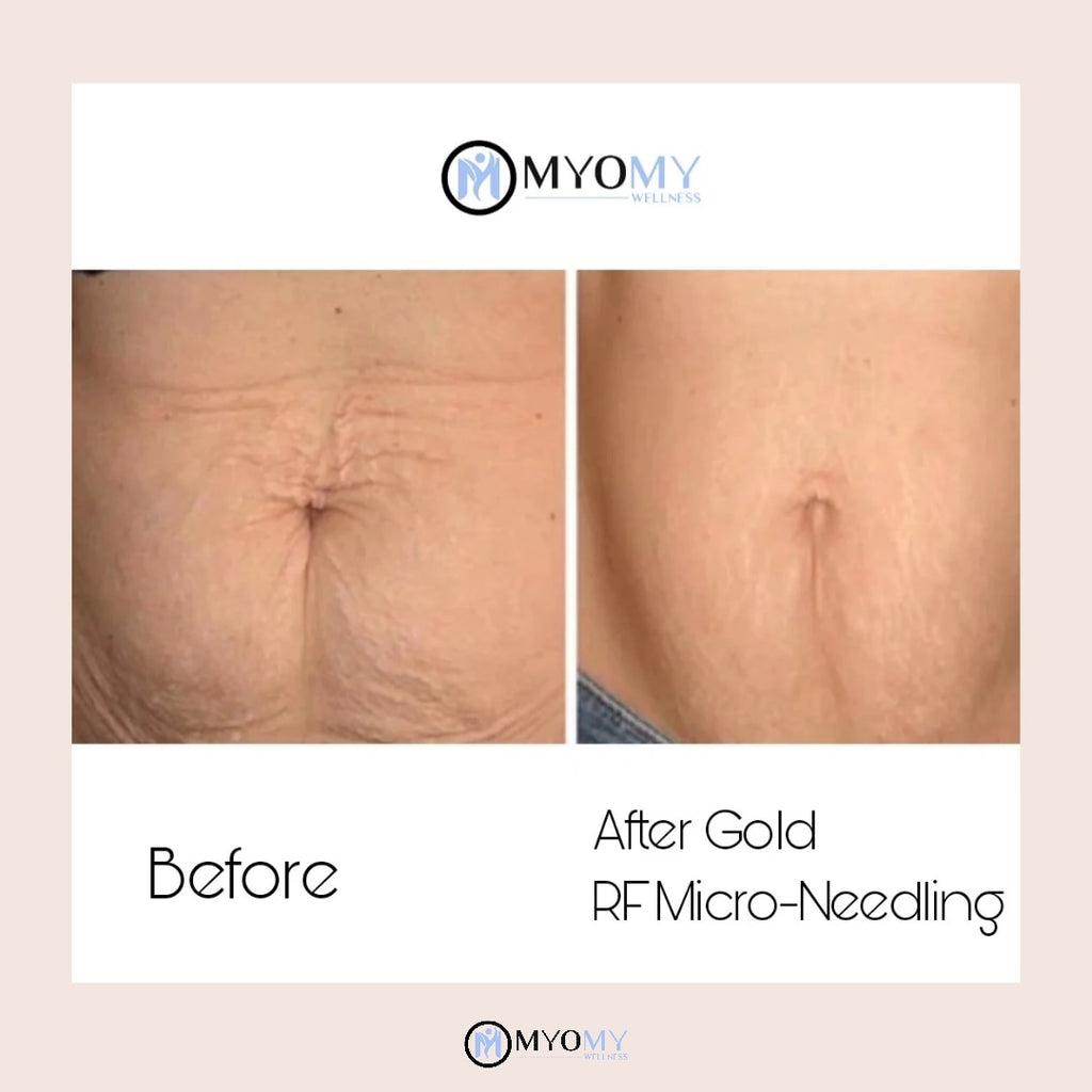 RF MICRONEEDLING & LED LIGHT THERAPY image 6