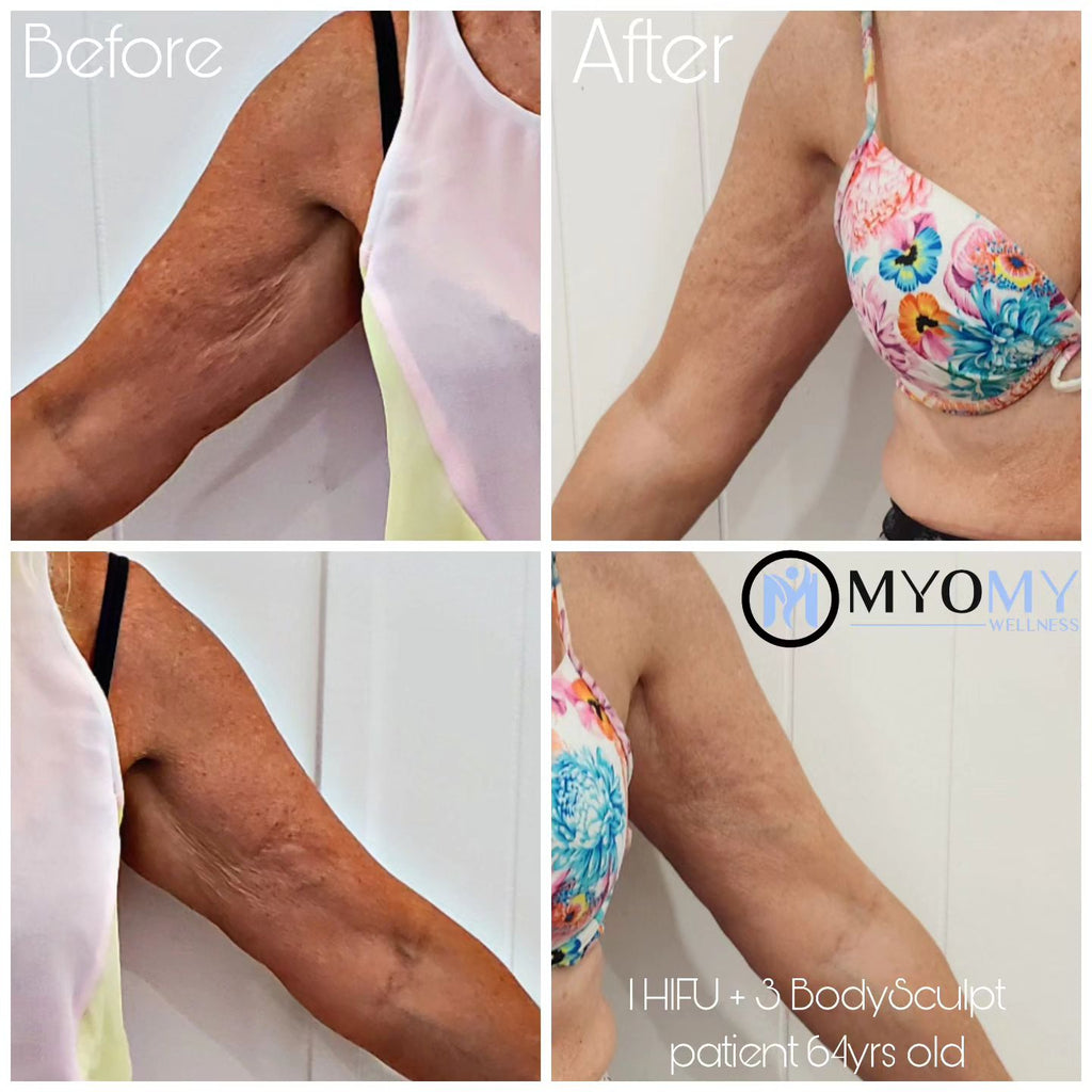 7D HIFU BODY FAT CAVITATION (ONE SESSION)