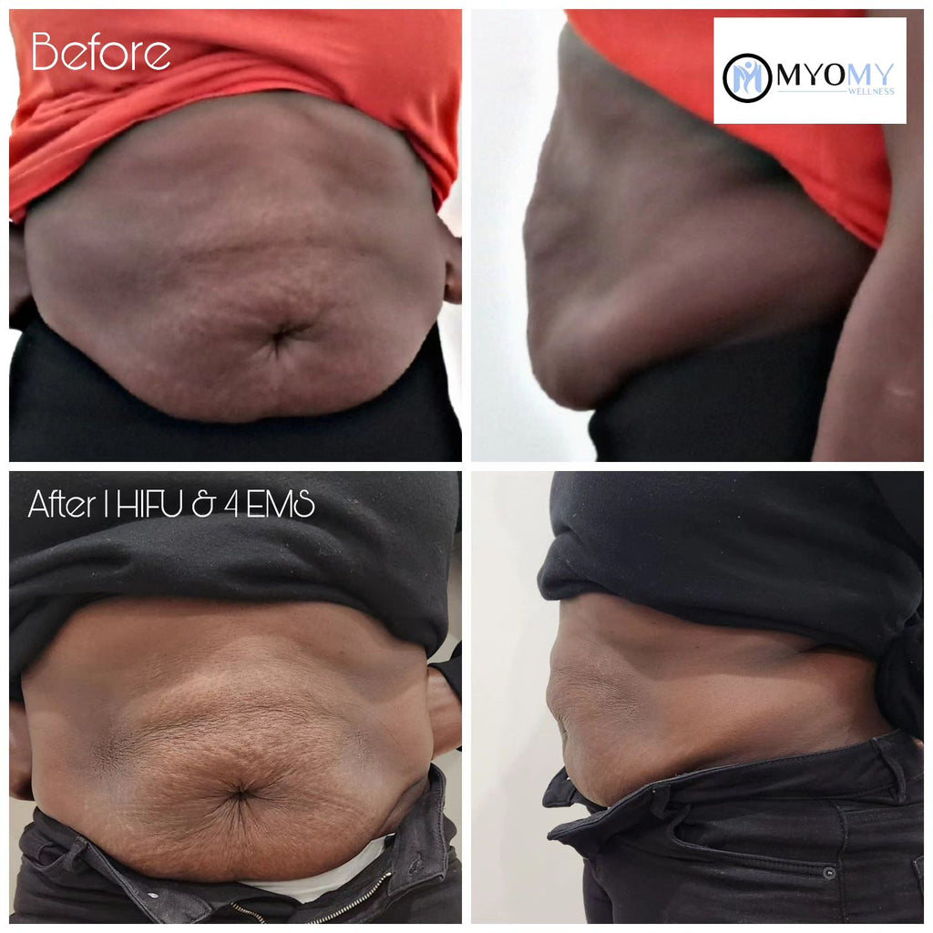 7D HIFU BODY FAT CAVITATION (ONE SESSION)