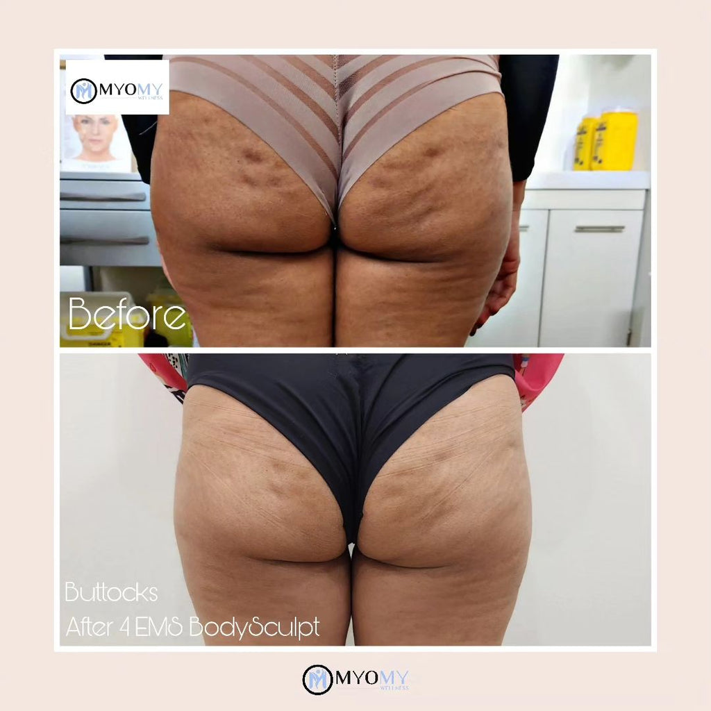 7D HIFU BODY FAT CAVITATION (ONE SESSION)