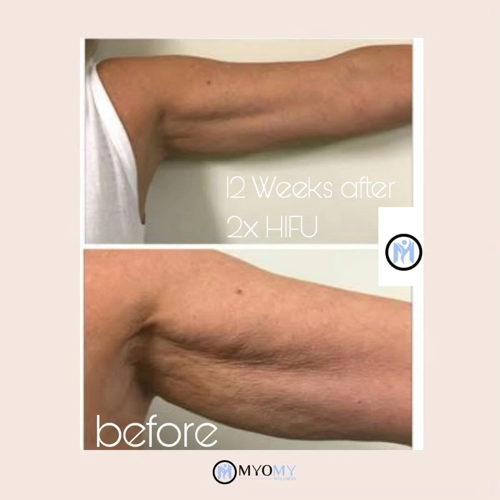 7D HIFU BODY FAT CAVITATION (ONE SESSION)