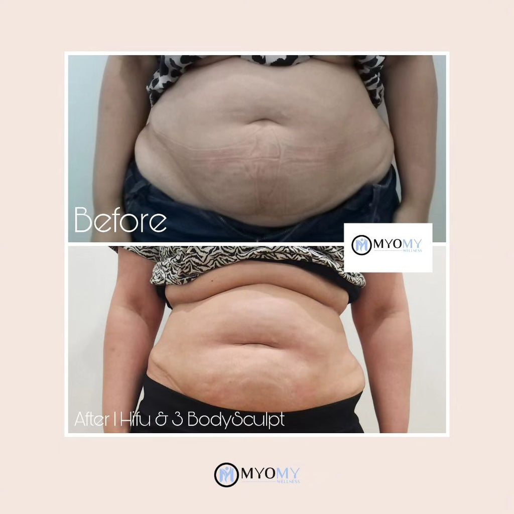 7D HIFU BODY FAT CAVITATION (ONE SESSION)