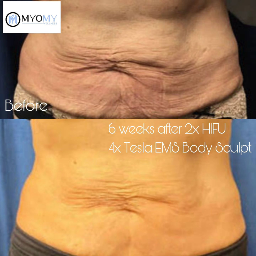 7D HIFU BODY FAT CAVITATION (ONE SESSION)