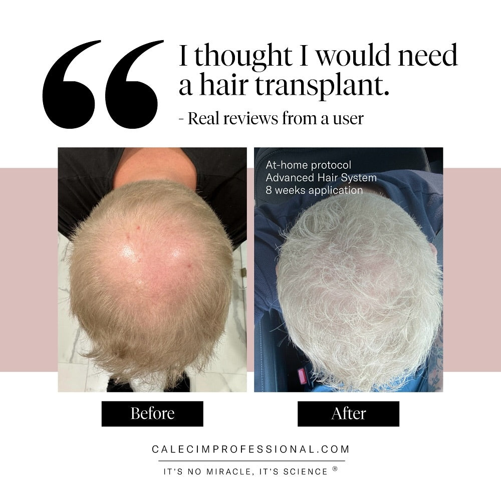 CALECIM ADVANCED 6 WEEK IN-CLINIC HAIR LOSS TREATMENT PROGRAM image 0