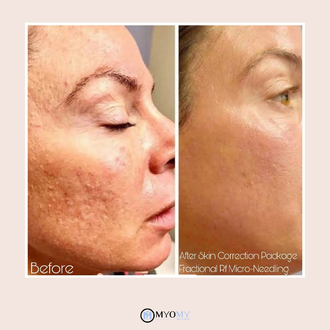 4 SESSIONS RF MICRONEEDLING image 2