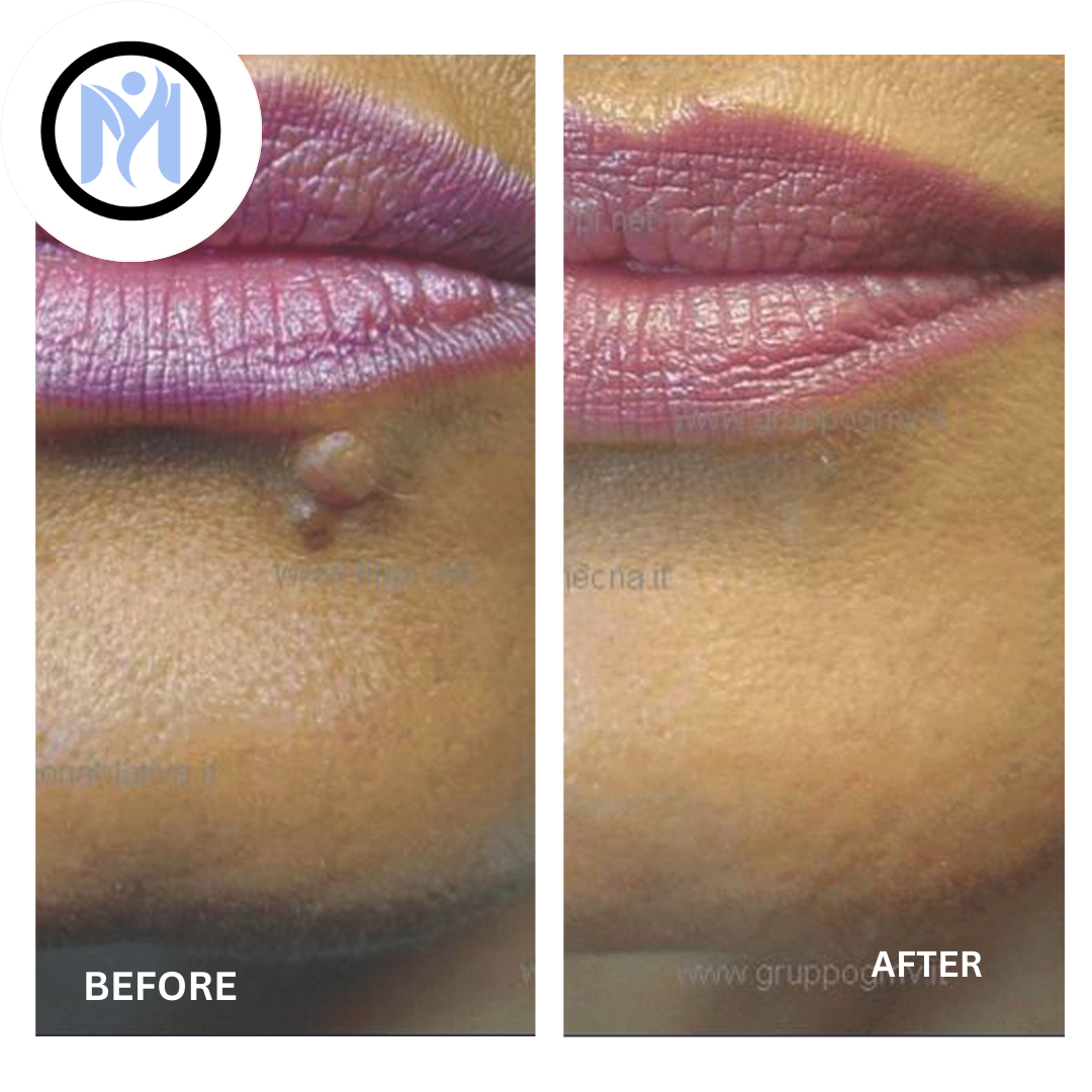 Plexr Plus Fibroblast Benign Lesion Removal - 2-5 image 0