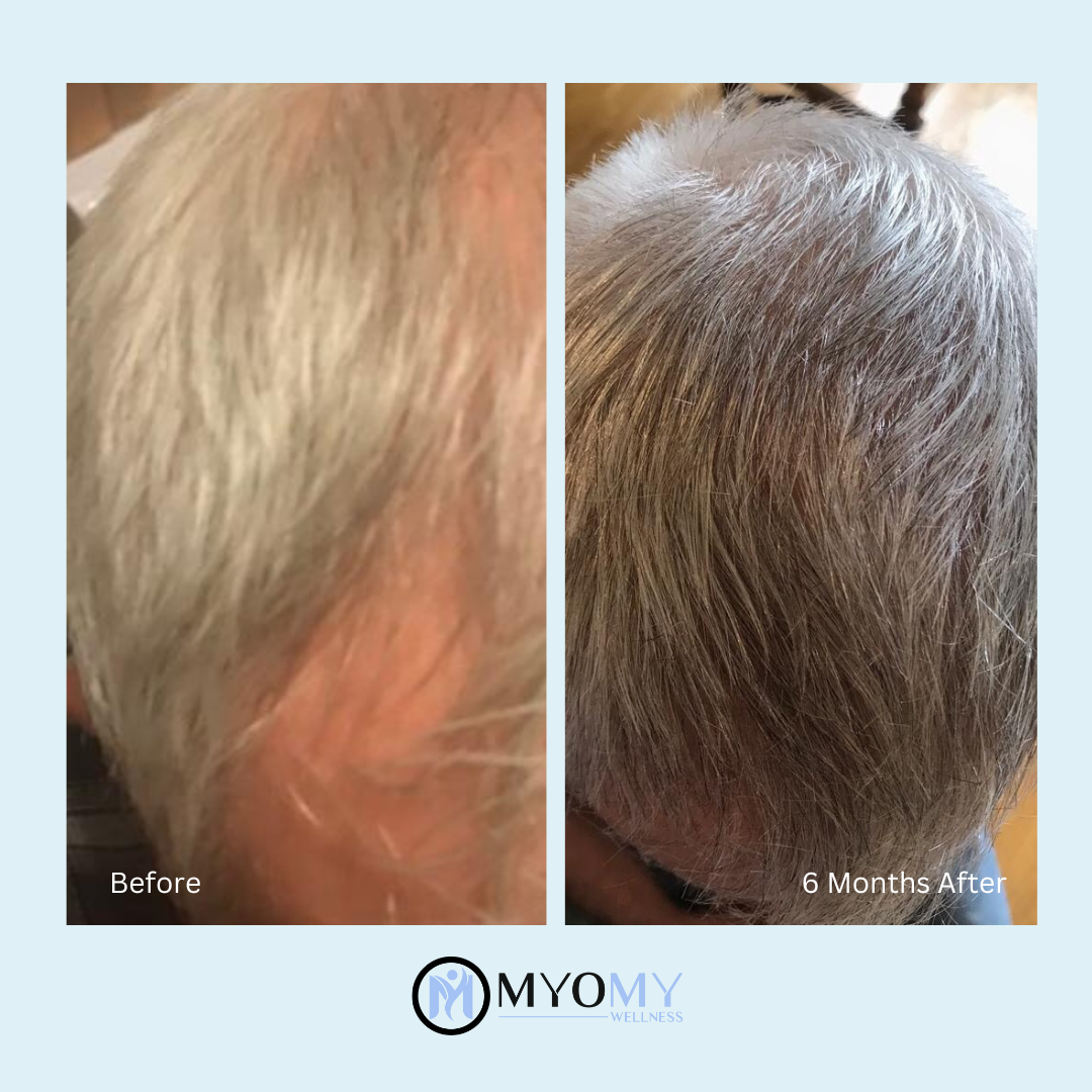 CALECIM ADVANCED 6 WEEK IN-CLINIC HAIR LOSS TREATMENT PROGRAM image 4