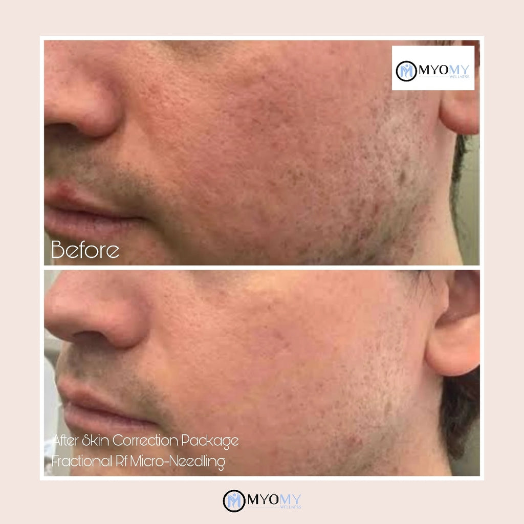 RF MICRONEEDLING FULL FACE image 5