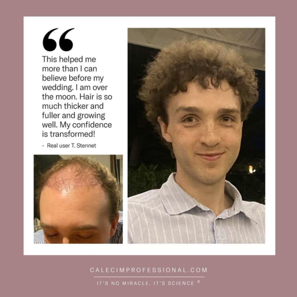 CALECIM ADVANCED 6 WEEK IN-CLINIC HAIR LOSS TREATMENT PROGRAM image 1