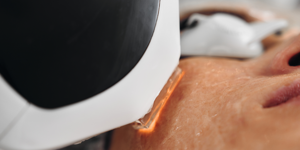 DPL Vascular Laser Facial image 1