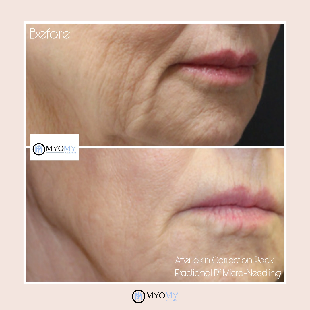 RF MICRONEEDLING & LED LIGHT THERAPY image 4