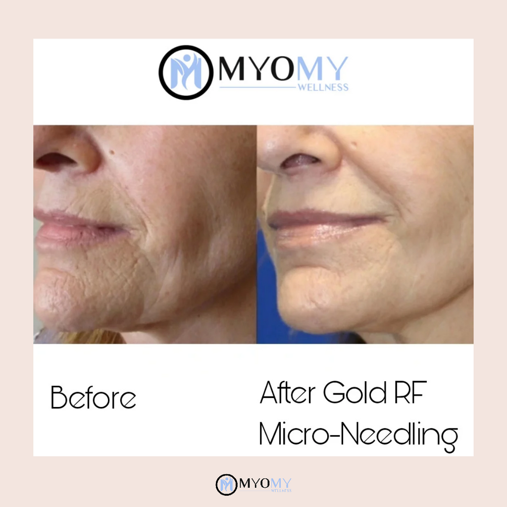 RF MICRONEEDLING & LED LIGHT THERAPY image 5