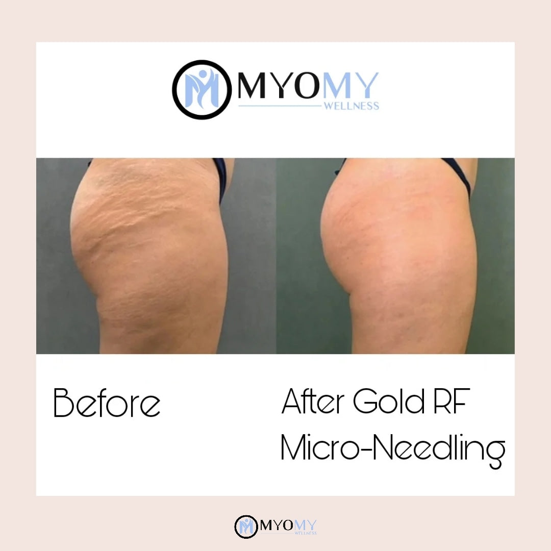 RF MICRONEEDLING & LED LIGHT THERAPY image 3