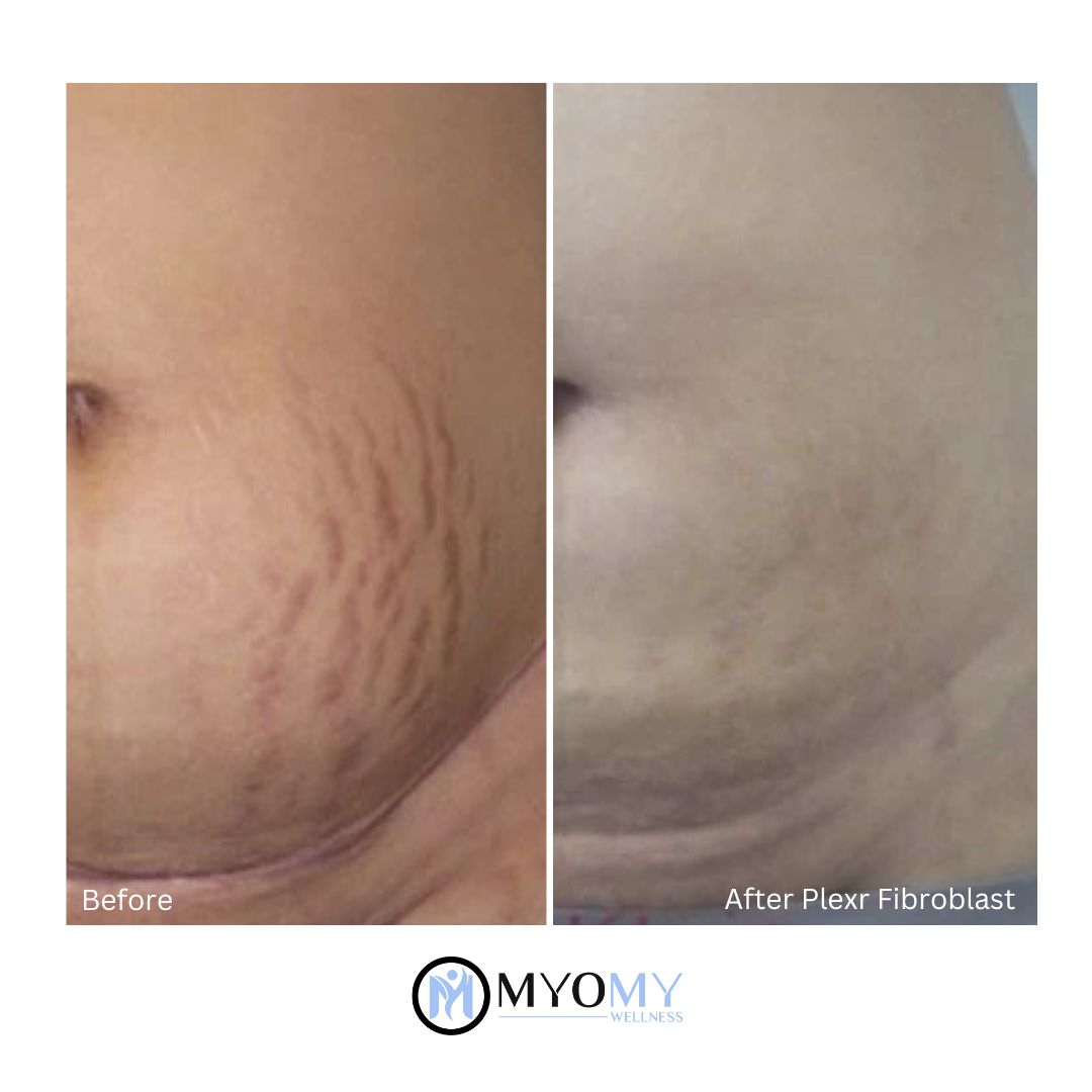 Plexr Plus Fibroblast Stretch Marks image 0