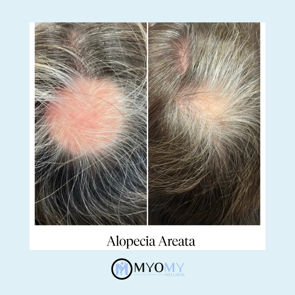 CALECIM ADVANCED 6 WEEK IN-CLINIC HAIR LOSS TREATMENT PROGRAM image 7