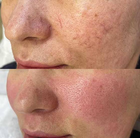 DPL Vascular Laser Facial image 0