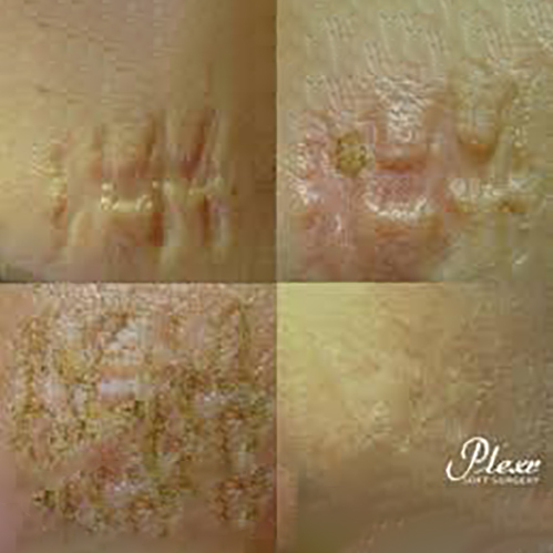 Plexr Plus Fibroblast Keloid Scar 0-5cm image 0