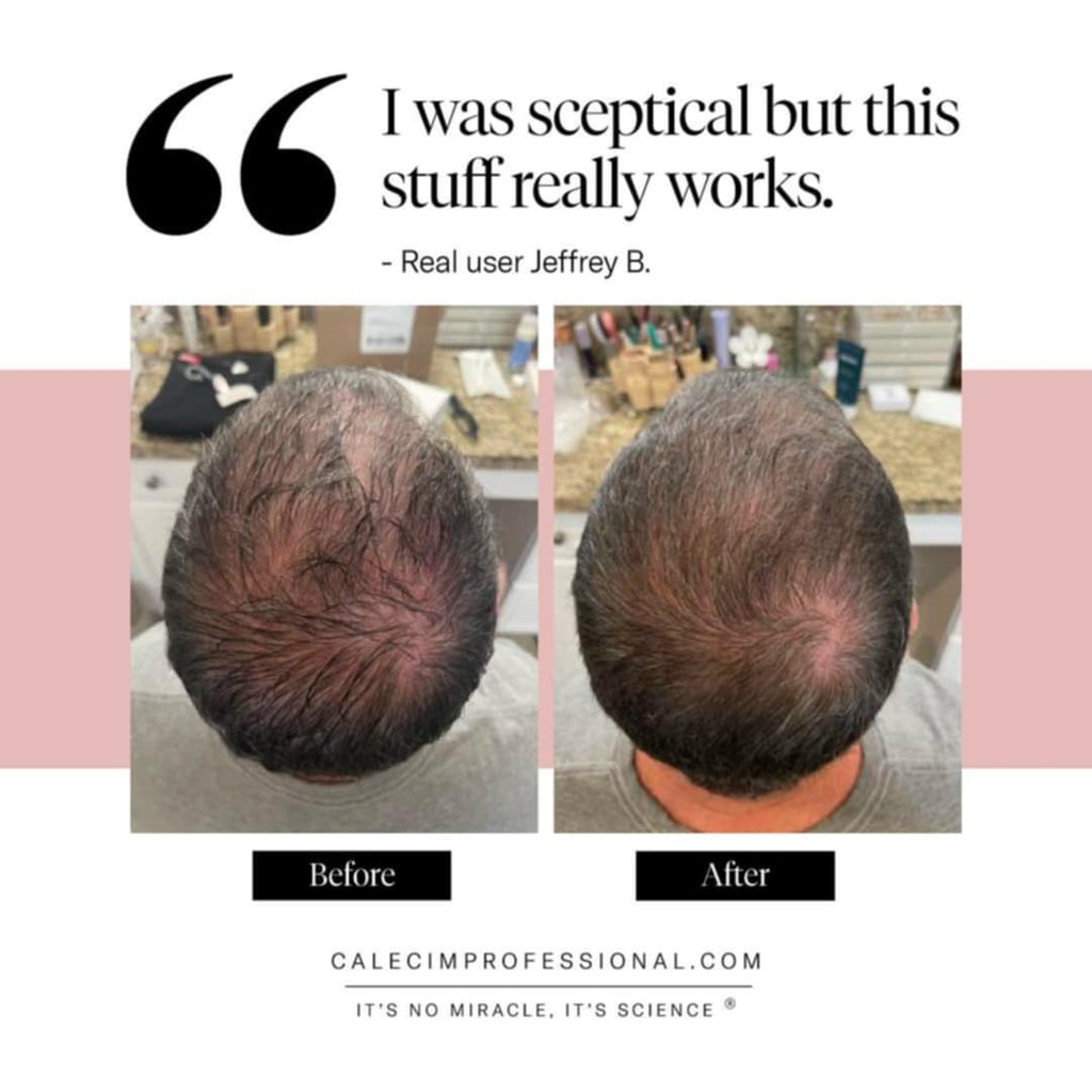 CALECIM ADVANCED HAIR REGROWTH SYSTEM (Home Program) image 5