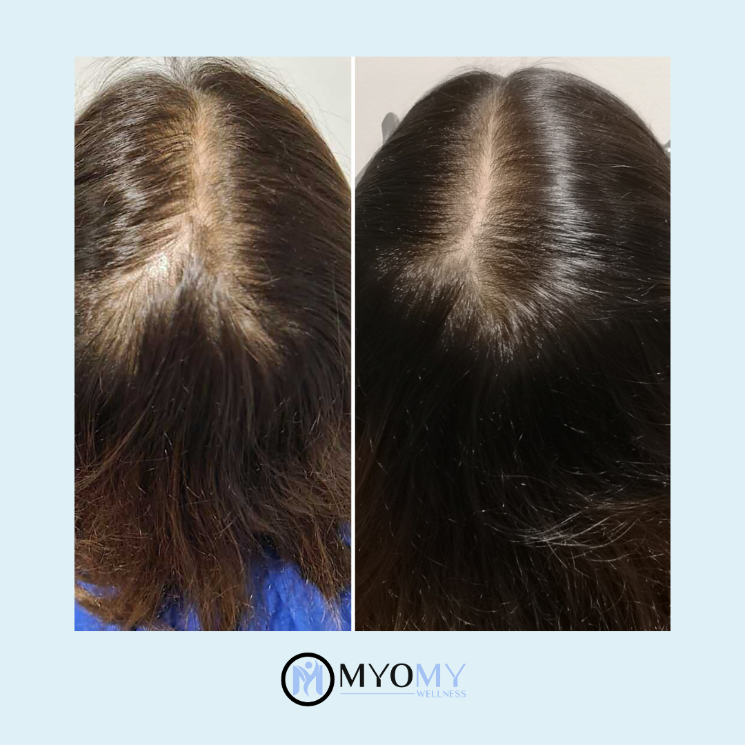 CALECIM ADVANCED 6 WEEK IN-CLINIC HAIR LOSS TREATMENT PROGRAM image 5