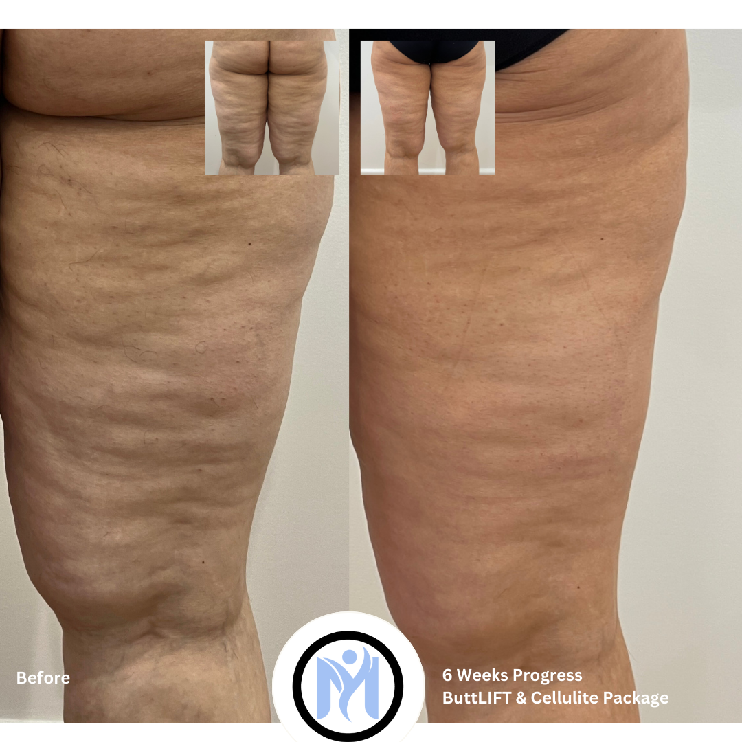 7D HIFU BODY FAT CAVITATION (ONE SESSION)