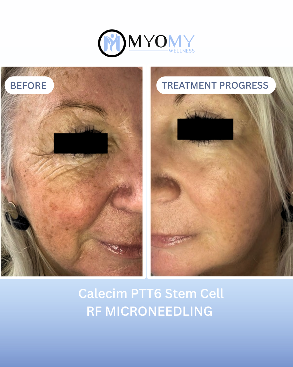 4x Laser Genesis with LED & 4x Stem Cell RF Microneedling Full Face + Neck