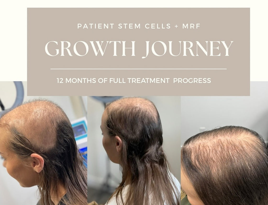 CALECIM ADVANCED PTT-6® HAIR REGROWTH SYSTEM (6 Week Home Program)