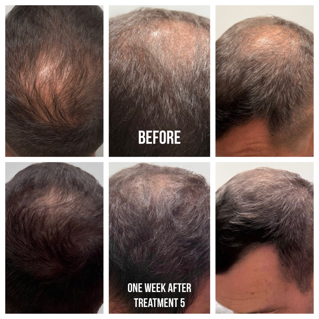 CALECIM ADVANCED PTT-6® HAIR REGROWTH SYSTEM (6 Week Home Program)