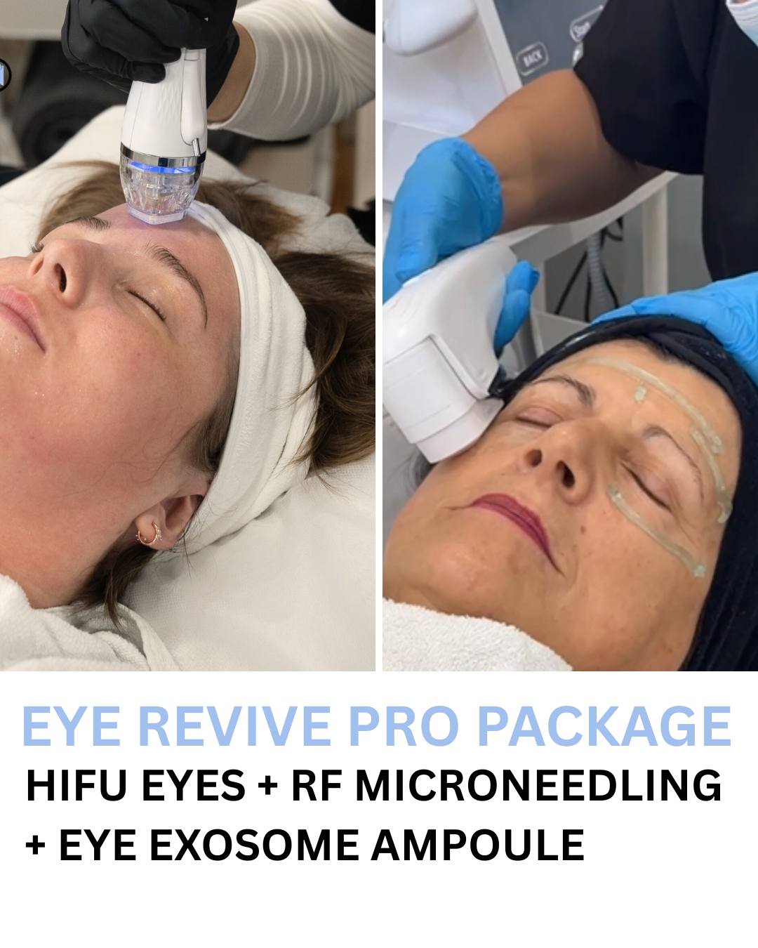 3 PACK EYE REVIVE PRO (HIFU & RF MICRONEEDLING + EXOSOMES)