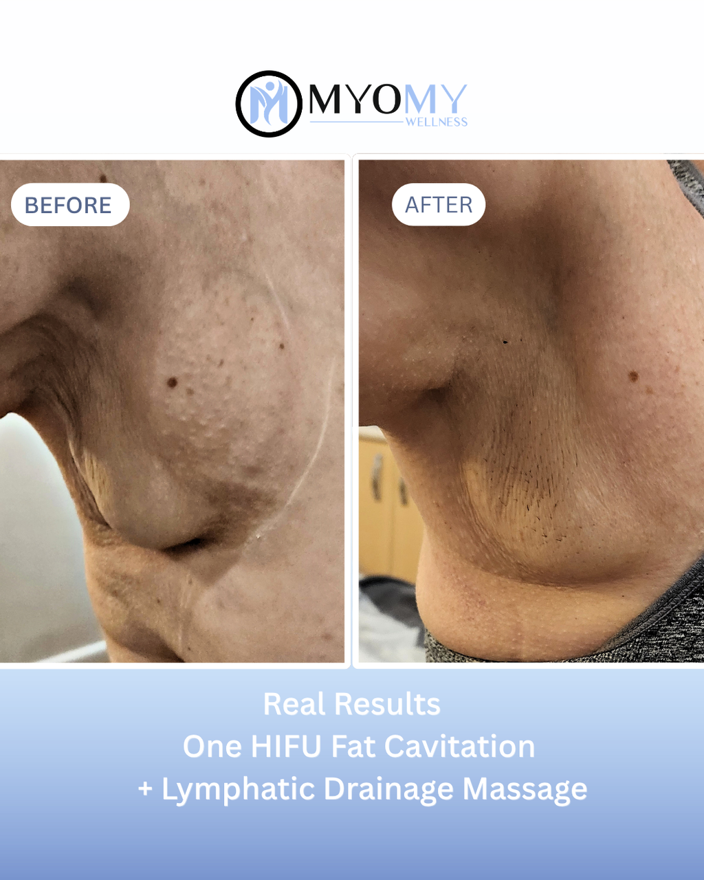 3 PACK HIFU LIPO BODY FAT CAVITATION (EOFYS)