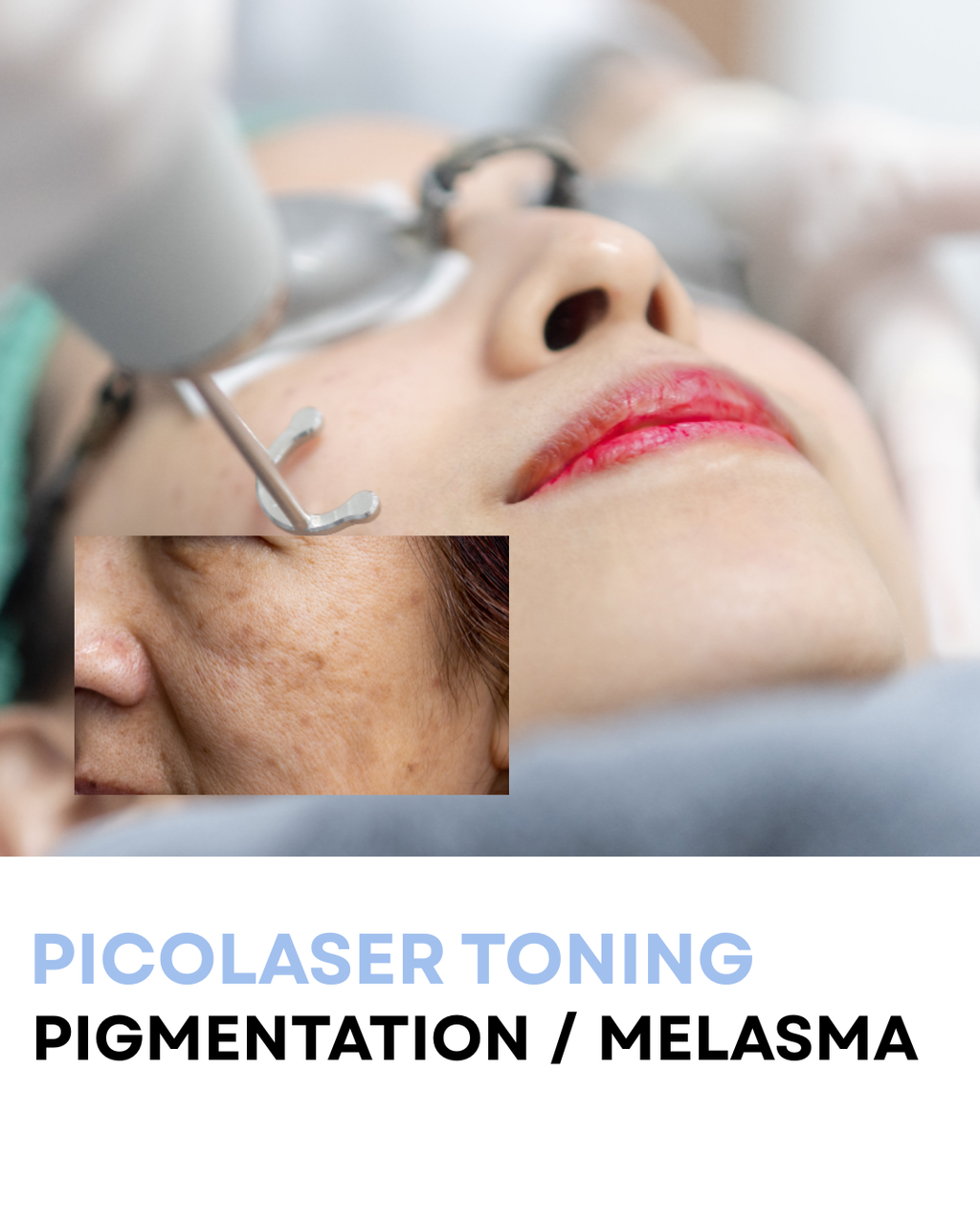 6 PACK OF PICOLASER TONING - PIGMENTATION/MELASMA (SAVE 40%)