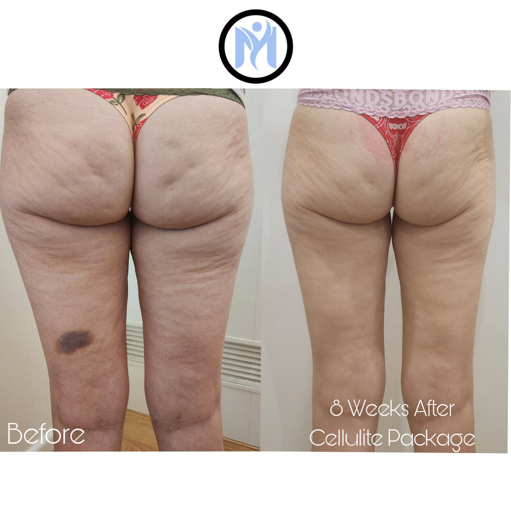 7D HIFU BODY FAT CAVITATION (ONE SESSION)