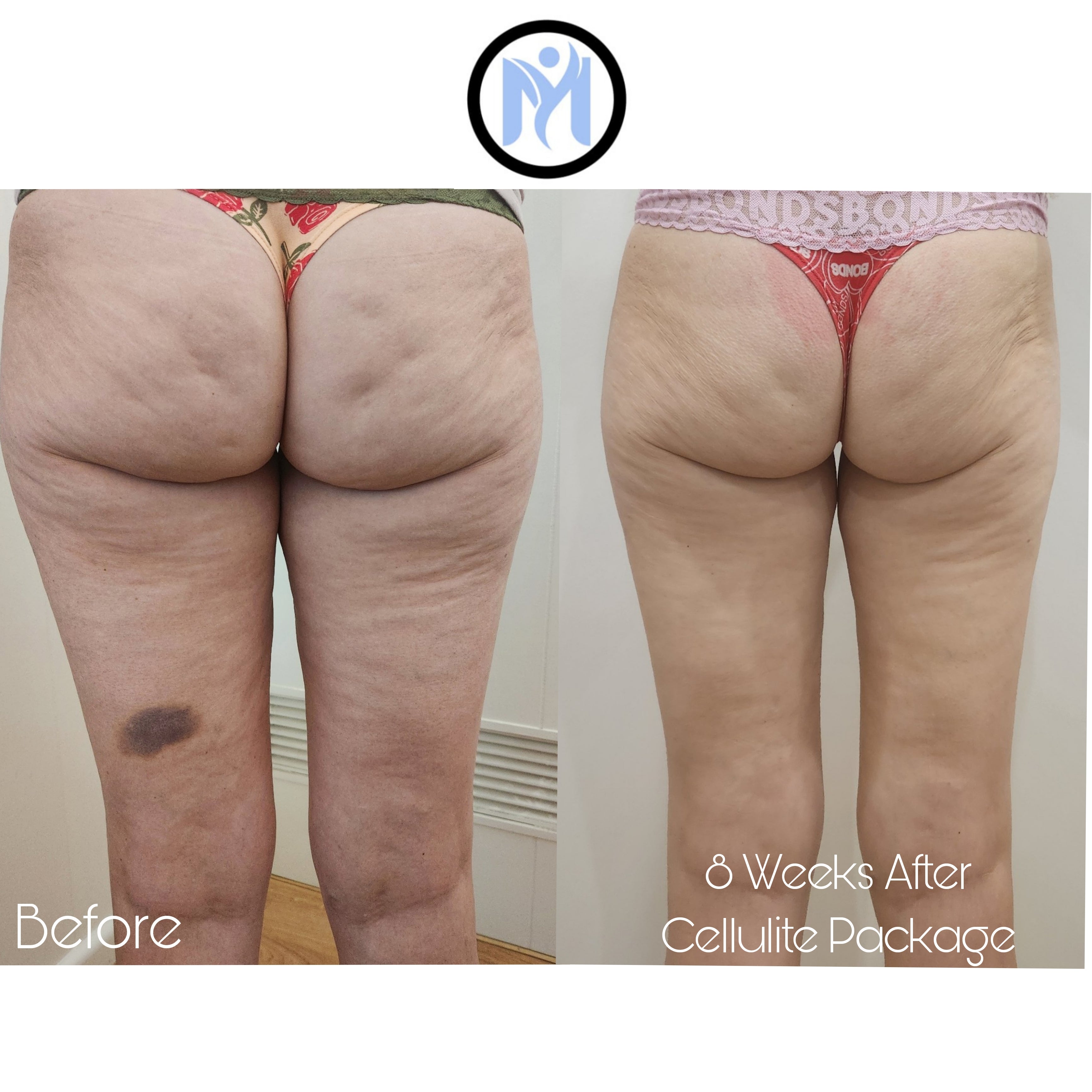7D HIFU BODY FAT CAVITATION (ONE SESSION)