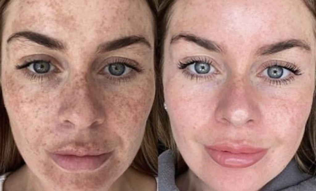 PIGMENTATION CLINICAL PEEL FACIAL WITH LED LIGHT THERAPY