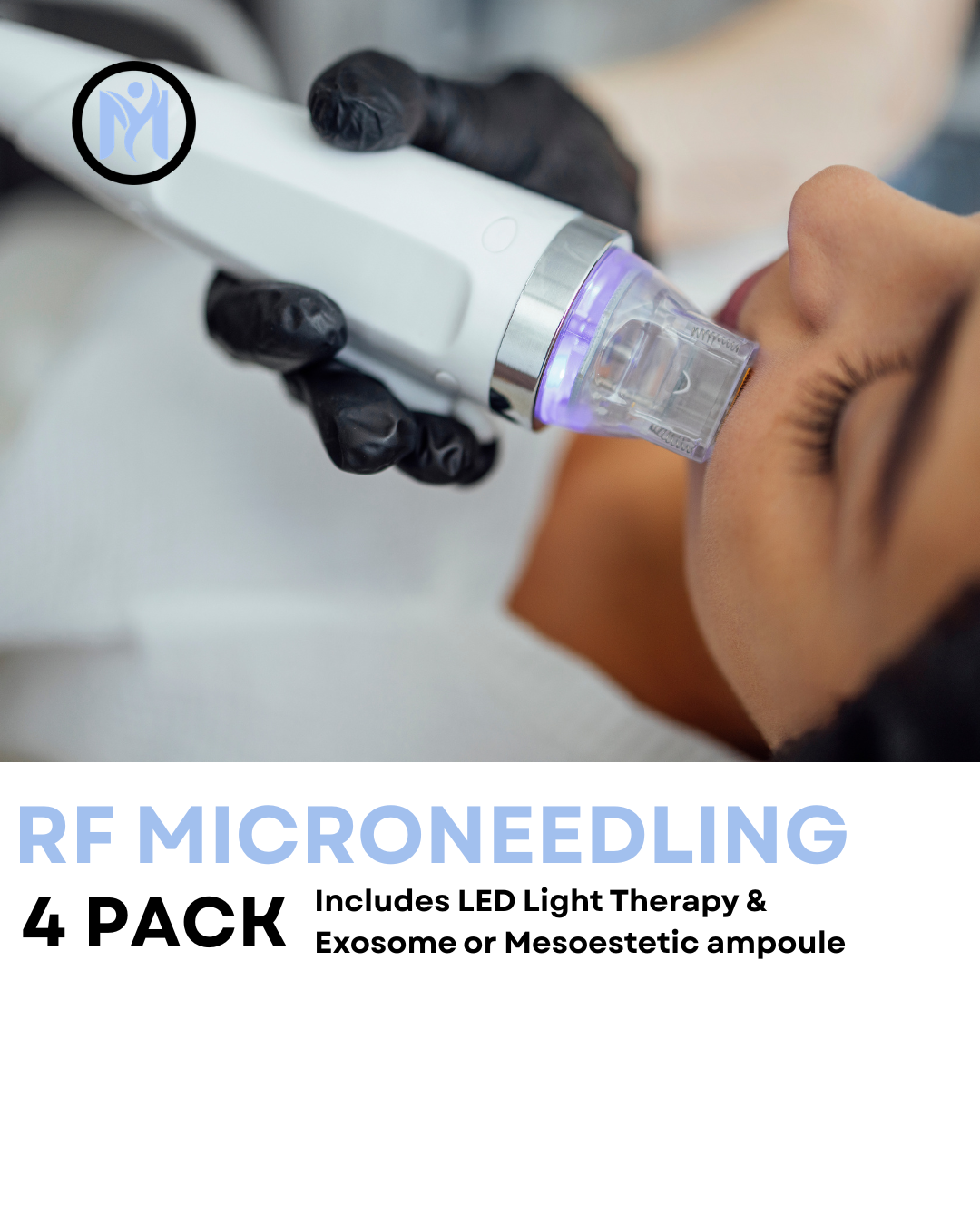 50% Off 4 SESSIONS RF MICRONEEDLING FULL FACE & NECK (Includes Exosomes & LED Light Therapy)