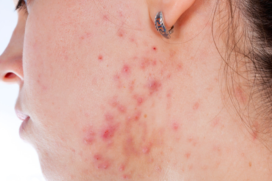 4 Pack DPL Laser Acne Treatment with LED