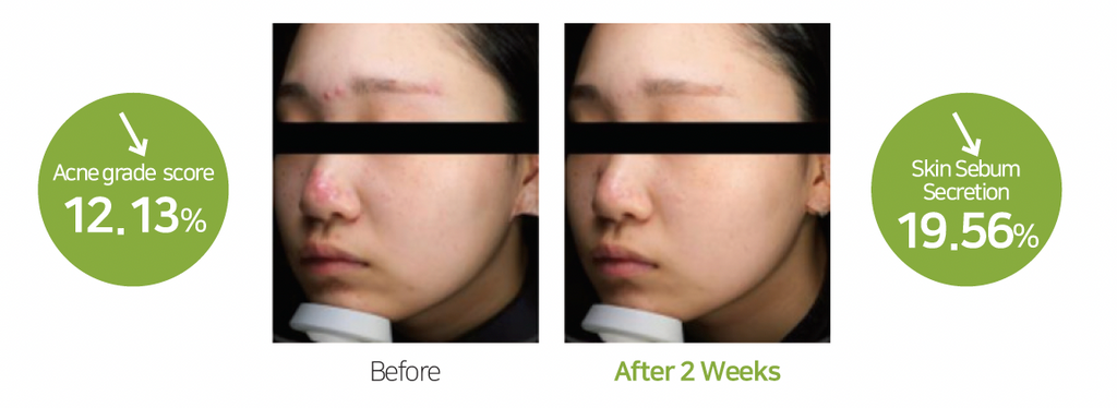 Korean Thermoceuticals DeAC Aciderm Serum 30ml