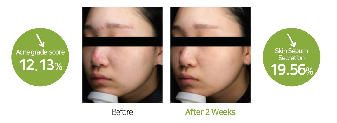 Korean Thermoceuticals DeAC Aciderm Serum 30ml