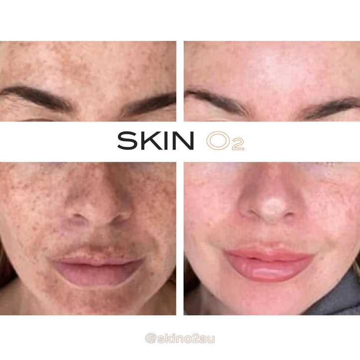 PIGMENTATION CLINICAL PEEL FACIAL WITH LED LIGHT THERAPY