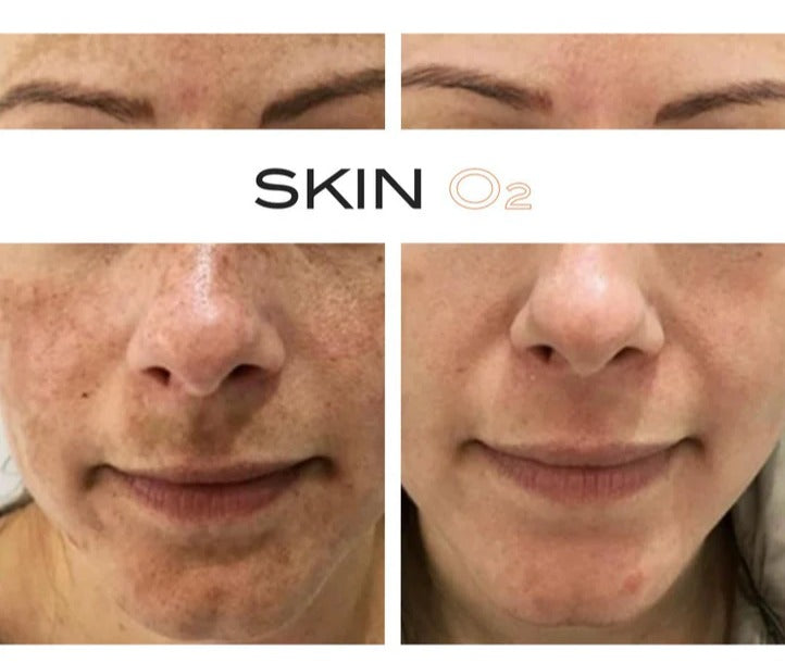 PIGMENTATION CLINICAL PEEL FACIAL WITH LED LIGHT THERAPY