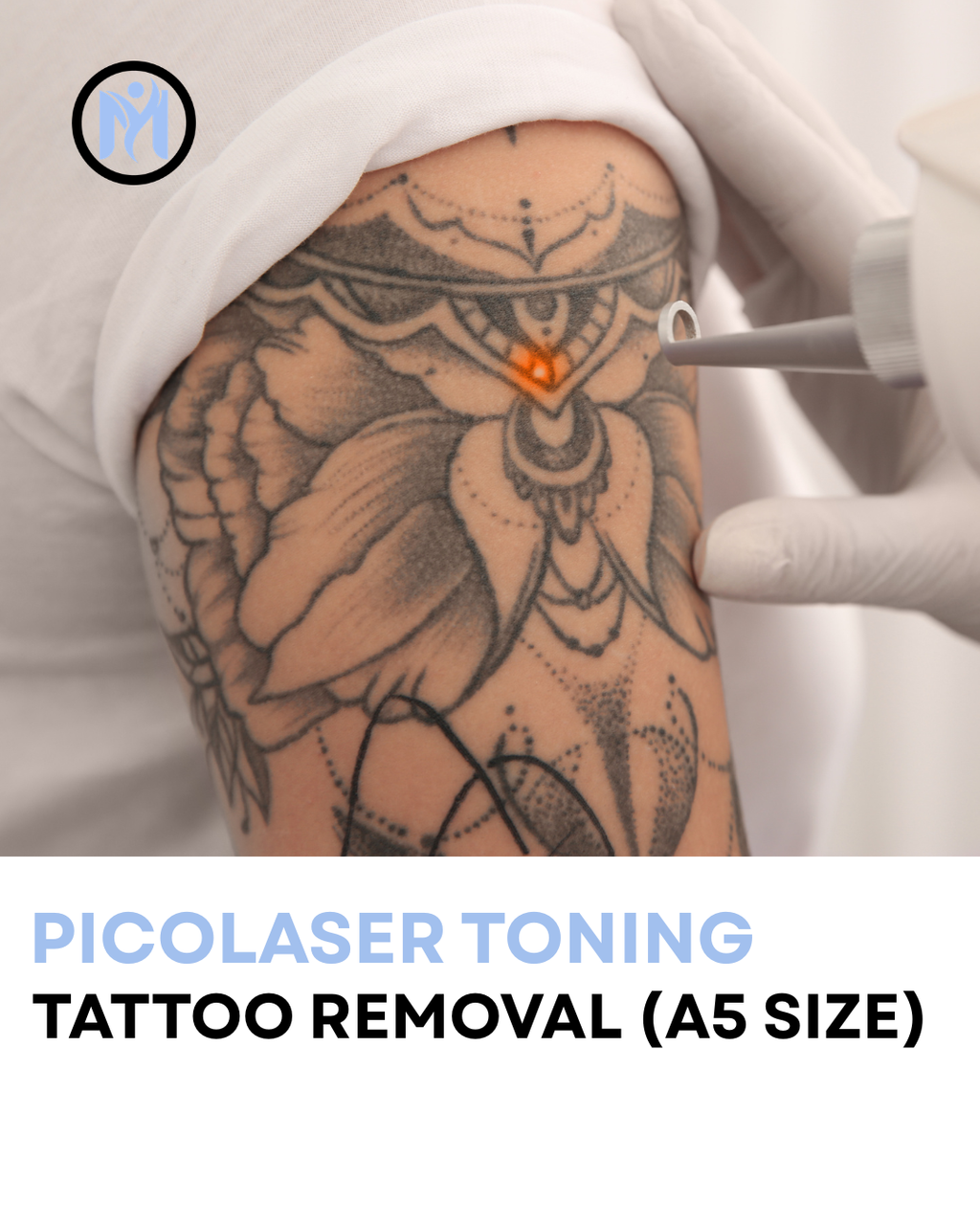 TATTOO REMOVAL A5 SIZE (HALF OF A4)