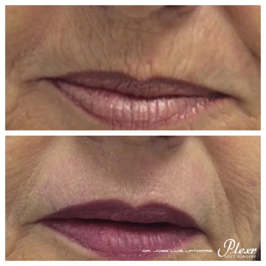 Plexr Plus Fibroblast Bar Code Lines - Upper Lip Lines Resurfacing image 0
