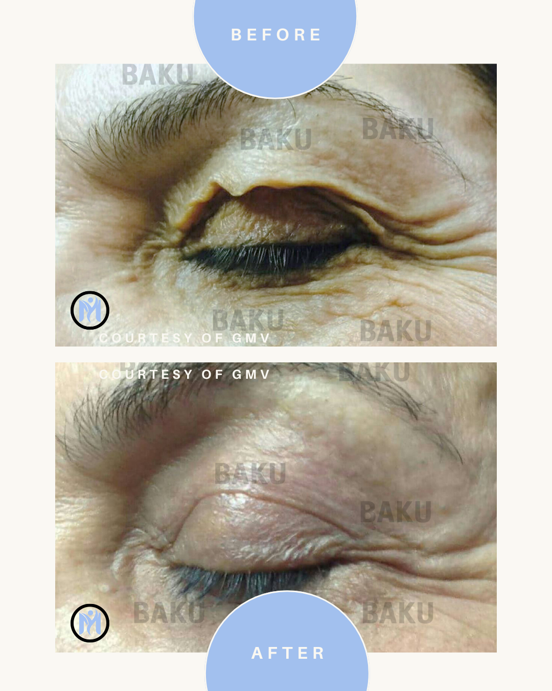 Plexr Plus Blepharoplasty Upper Eyelid Removal Sublimination image 0