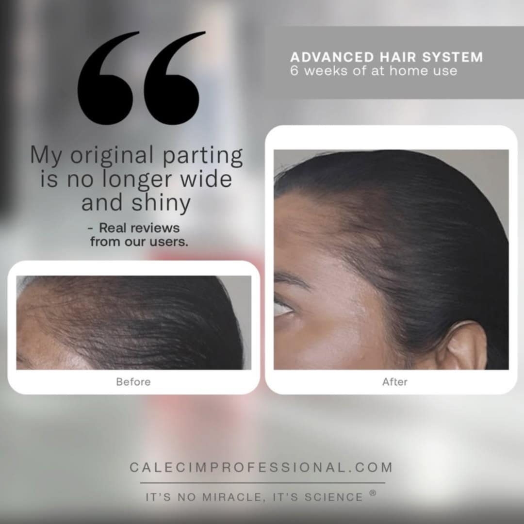 CALECIM ADVANCED HAIR REGROWTH SYSTEM (Home Program) image 3