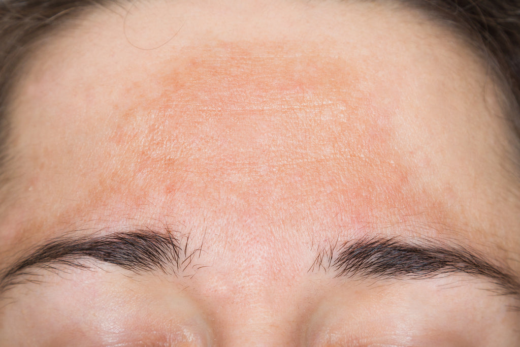 DPL Laser Pigmentation Facial image 0