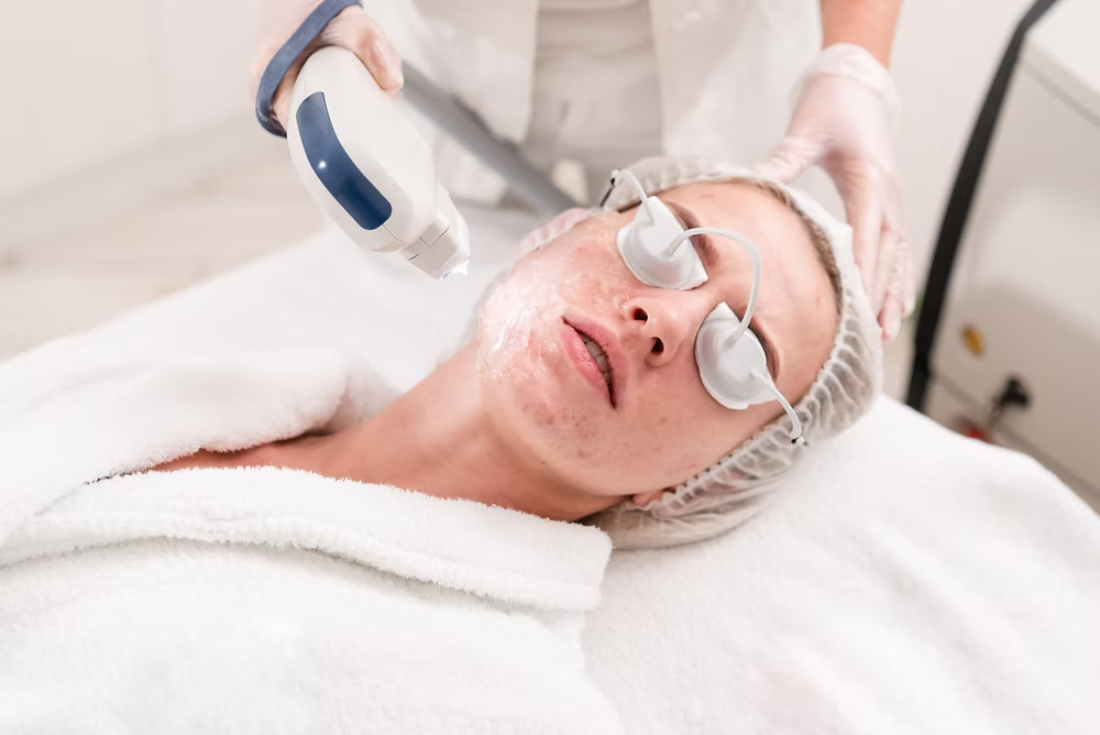 DPL Laser Acne  Facial Treatment