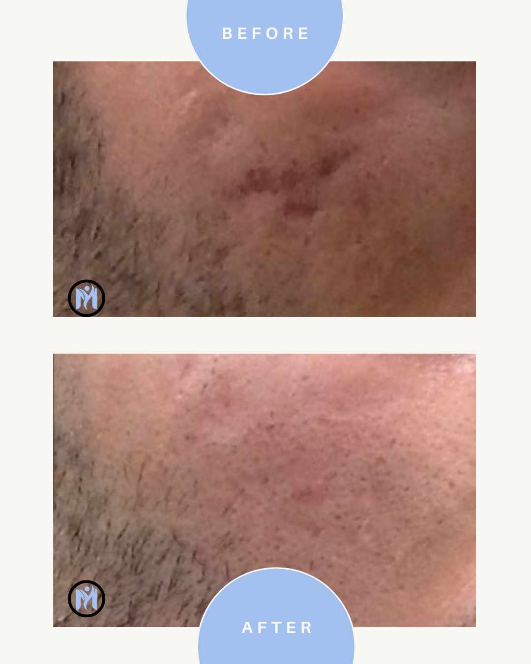 Plexr Plus Fibroblast Acne Scar Remodeling and removal image 0
