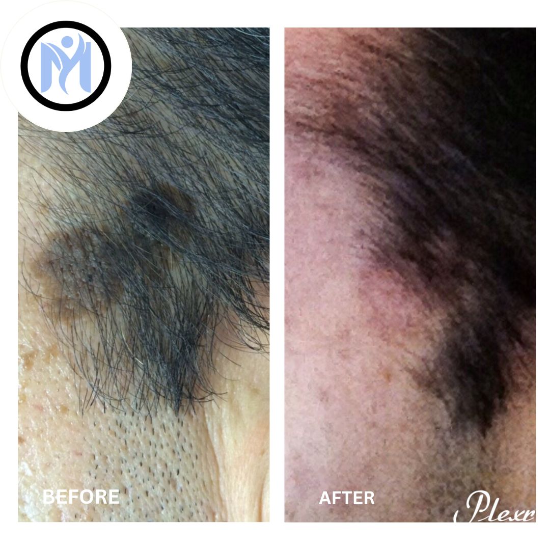 Plexr Plus Fibroblast Seborrheic Keratosis 0-5cm image 0