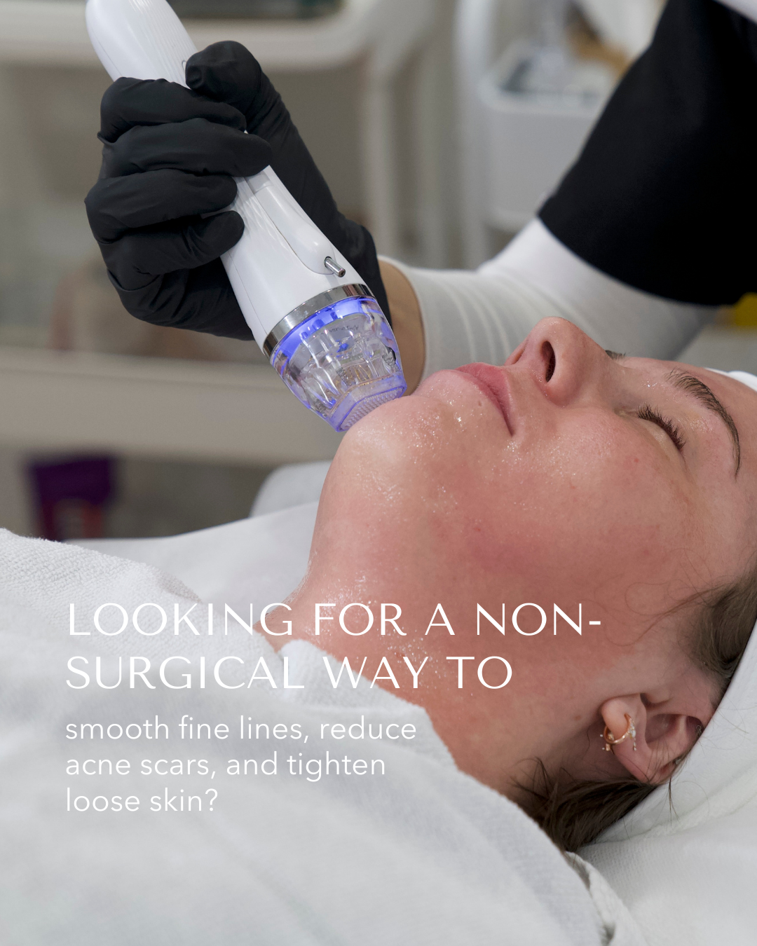 Stem Cell RF Microneedling Full Face + Neck image 2