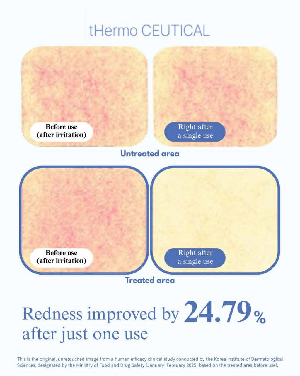 DPL Vascular Laser Facial with Exosome Booster + LED – Redness and Rosacea Relief