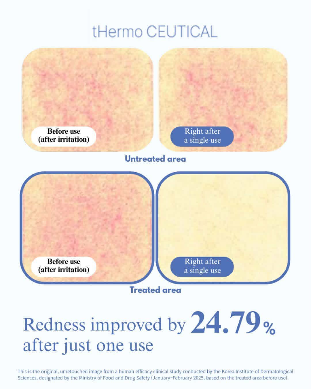DPL Vascular Laser Facial with Exosome Booster + LED – Redness and Rosacea Relief